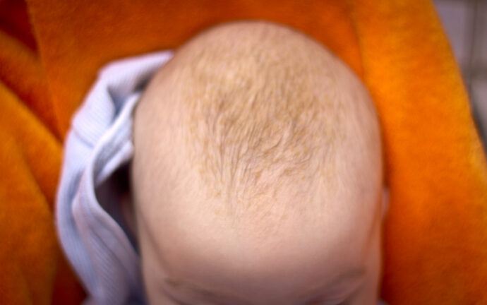 Milchschorf Baby Kopfgneis
