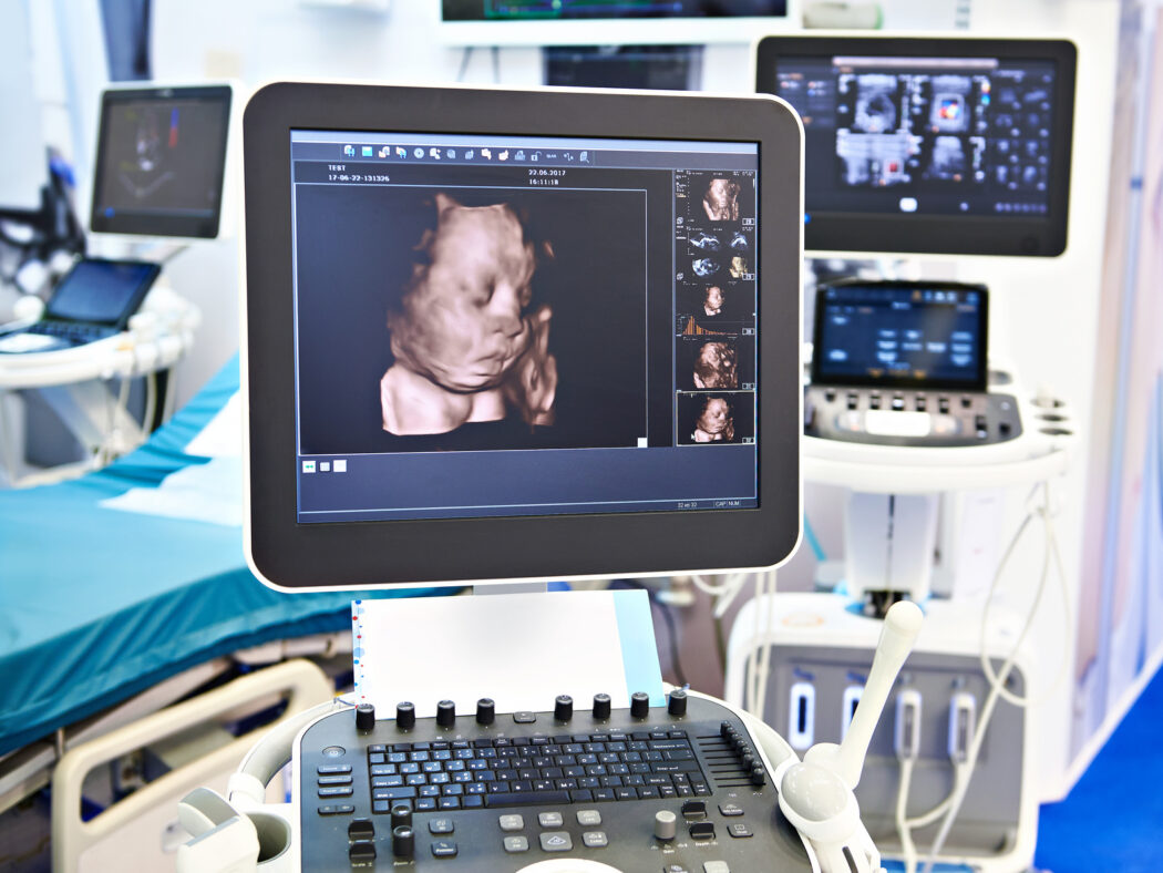 3d ultraschall gerät schwangerschaft, wie viel kostet 3d ultraschall, welche ssw 3d ultraschall
