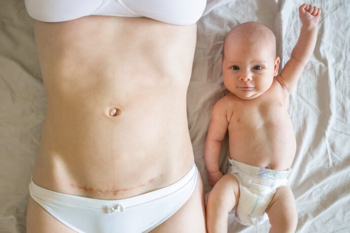 wochenfluss nach kaiserschnitt wie lange, farbe, nur eine woche; Frau mit Kaiserschnittnarbe und Baby