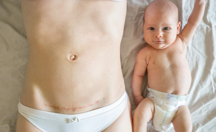 wochenfluss nach kaiserschnitt wie lange, farbe, nur eine woche; Frau mit Kaiserschnittnarbe und Baby