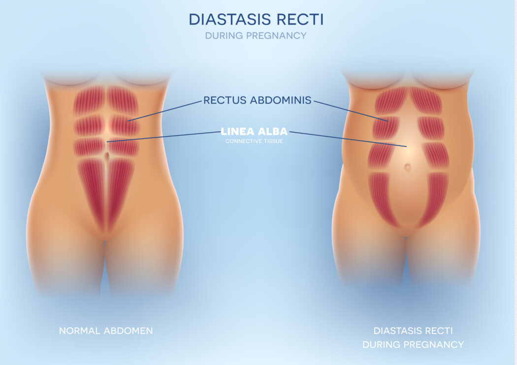 vergleich bauchmuskeln mit rektusdiastase während schwangerschaft und normale bauchmuskeln